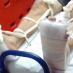 Em Limeira, homem furta clínica médica e quebra os pés ao tentar fugir