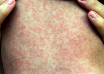 Sarampo: homem morre em SP; é a 1ª morte provocada pela doença no estado desde 1997