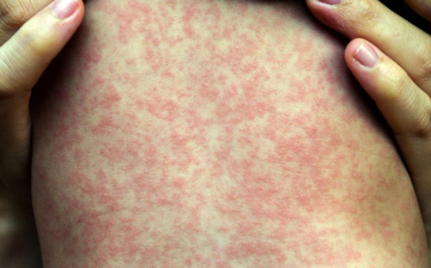 Sarampo: homem morre em SP; é a 1ª morte provocada pela doença no estado desde 1997