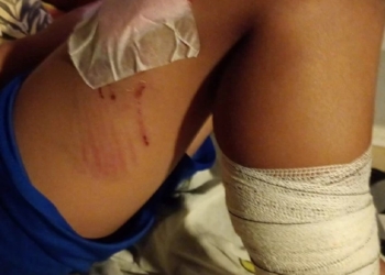 Três crianças são atacadas por pitbull dentro de condomínio