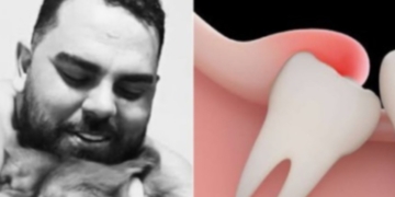 Jovem morre após fazer cirurgia de extração de dentes do siso