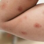 Piracicaba registra caso suspeito de mpox; resultado do exame é aguardado